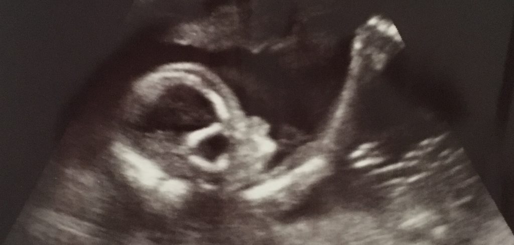 Baby Kerr Ultrasound